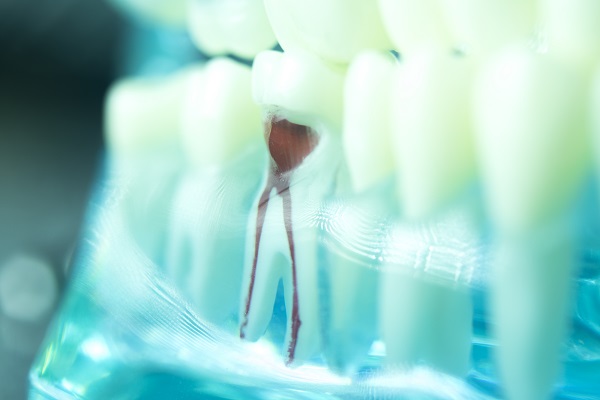 The FAQs Of Root Canal Treatment