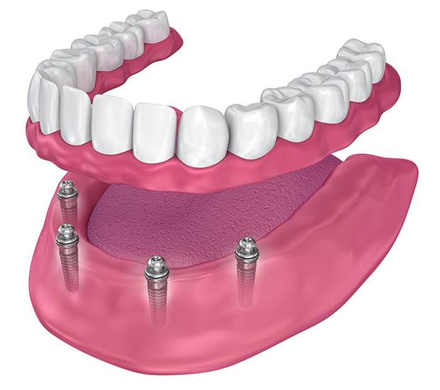 teeth in a day