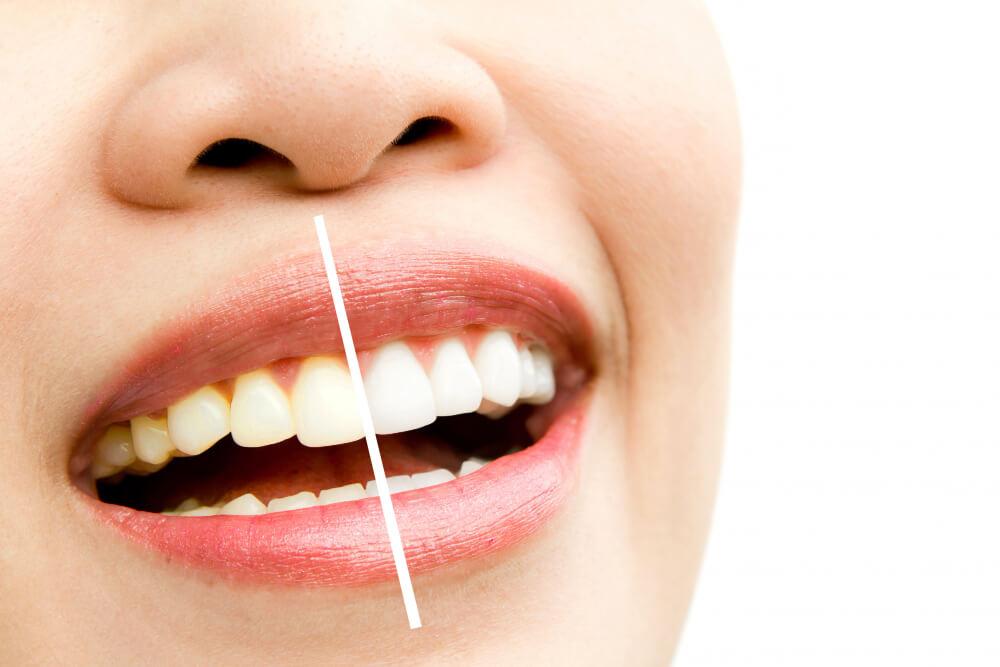 a before and after teeth whitening