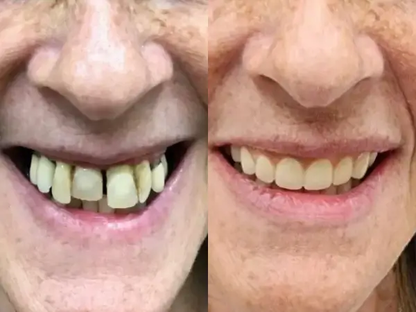 Close-up of patient's teeth before dental treatment showing gaps and discoloration