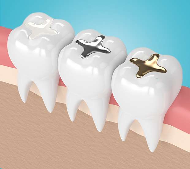 Manalapan Township Composite Fillings