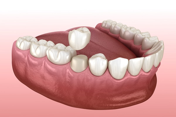 How A Dental Crown Is Used For A Damaged Tooth