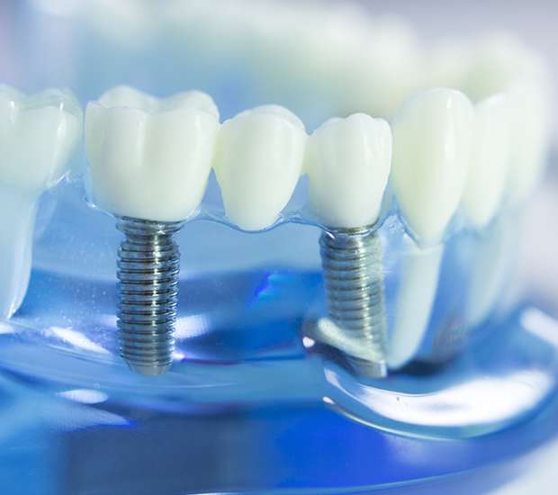 Manalapan Township Dental Implants