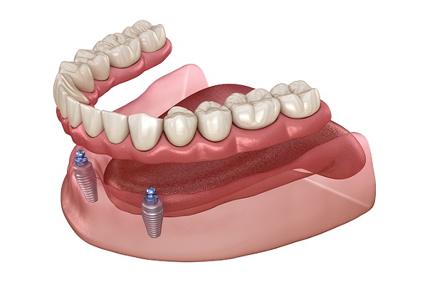 Implant Supported Dentures Manalapan Township, NJ