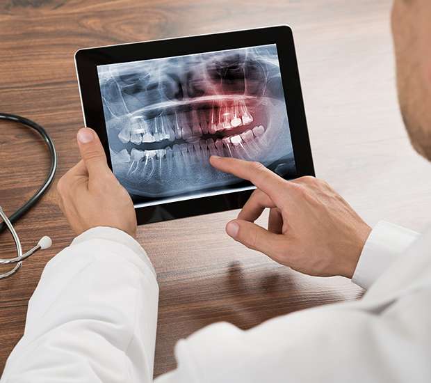 Manalapan Township Types of Dental Root Fractures